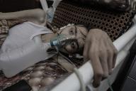 May 16, 2024 - Gaza: A Palestinian young man, Abdul Majeed Al-Sabakhi, 20, is undergoing treatment at Al-Aqsa Martyrs Hospital in Deir Al-Balah, on 16 May 2024. where he suffers from severe lung infections after being exposed to toxic gases from an Israeli missile that targeted his neighborsâ house. Al-Sabakhi weighed 55 kilos before the war, while after inhaling Israeli gas, he became It weighs 20 kilos. (Omar Ashtawy/APAImages/Polaris